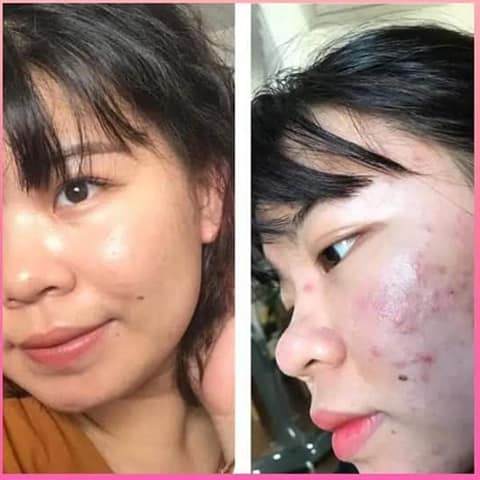 Gel Trị Mụn Klenzit C & Klenzit MS