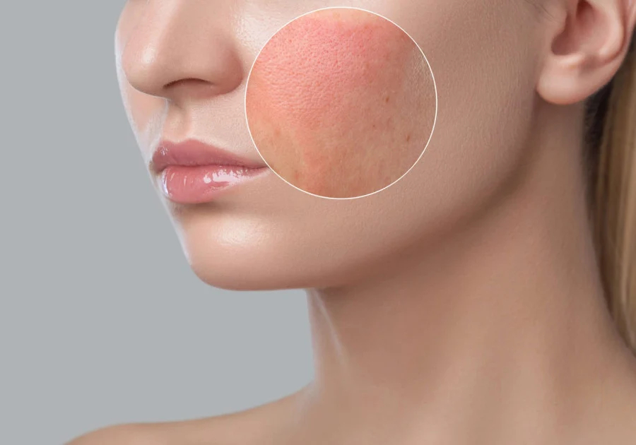 Vì Sao Bôi Kem Dưỡng Ẩm Bị Nóng Mặt? Nguyên Nhân Và Cách Xử Lý An Toàn